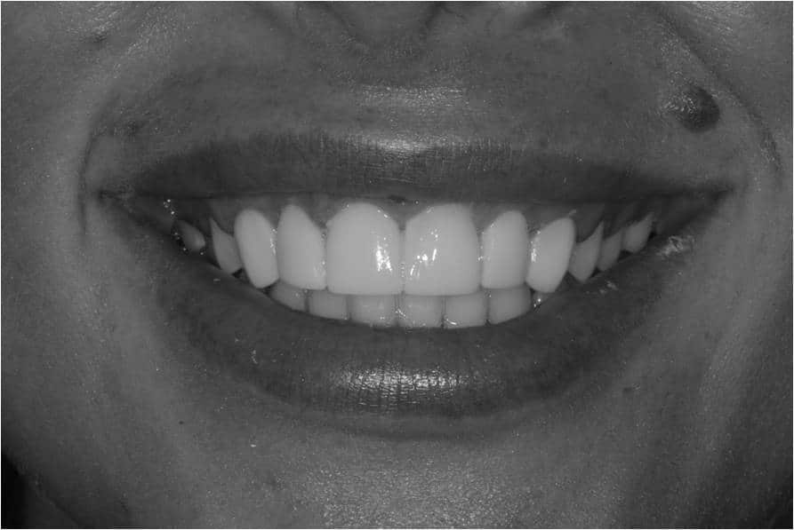 What is Dental Bonding? Image