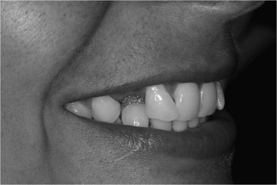 Are you not smiling because of missing teeth? Image