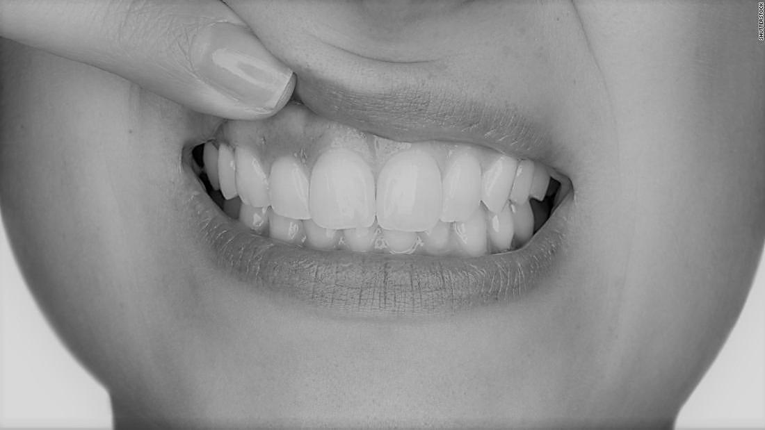 What is Gum Disease? Thumbnail